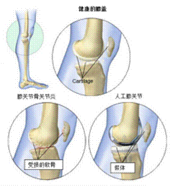 26项临床实验证明，间充质干细胞治疗膝骨关节炎有效，其疗法已经成功上市