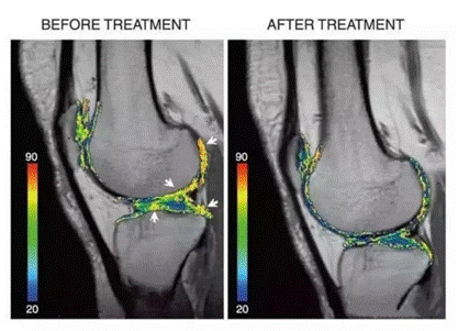 26项临床实验证明，间充质干细胞治疗膝骨关节炎有效，其疗法已经成功上市