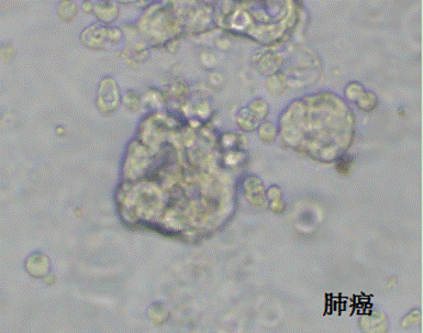 医学药筛新变革｜世界首例由实体瘤癌症患者为来源的类器官，成功筛选到临床候选药物！